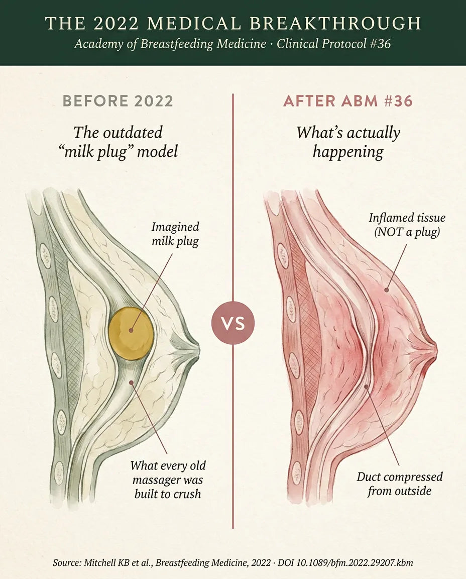 Before 2022 vs After ABM Protocol #36: outdated milk plug model on the left, inflamed tissue compressing duct from outside on the right. Source: Mitchell KB et al., Breastfeeding Medicine, 2022.